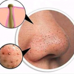 Tips Cara Menghilangkan Komedo